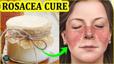 How To Get Rid of Rosacea Naturally | Rosacea Treatment at Home 6 1683390152 maxresdefault