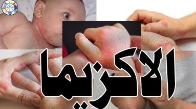 اسباب الاصابه بحساسيه الجلد المزمنه( #الاكزيما )وكيفيه العلاج منها ان شاء الله 8 1683581693 maxresdefault