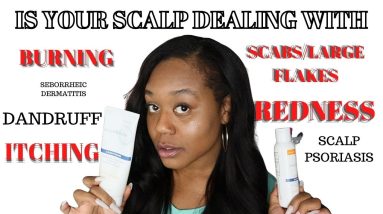 DANDRUFF BURNING, ITCHING & PAINFUL SCALP? HOW YOU FIX IT & THE CAUSE! CYN DOLL FEA. KENKODERM 16 1683622259 maxresdefault