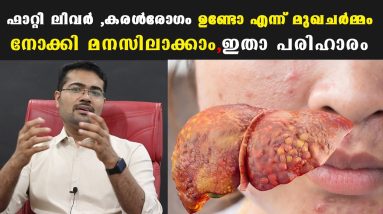 മുഖത്ത് കാണുന്ന ഈ മാറ്റം ആണ് കരള് രോഗത്തിന്റെ ആദ്യ ലക്ഷണം /Baiju's Vlogs /Dr Manoj Johnson 14 1683662682 maxresdefault
