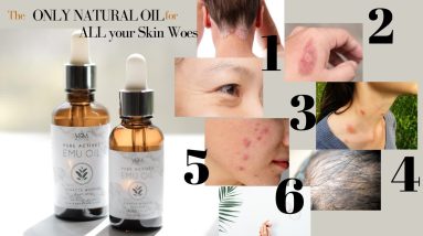 EMU OIL FOR ALL SKIN PROBLEMS (Psoriasis, Skin Asthma, Acne, Insect Bites, Burns, Wounds, Wrinkles) 2 1683729058 maxresdefault