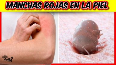 🔥✅ 9 Razones por las que aparecen MANCHAS ROJAS EN LA PIEL ➜ ECCEMAS EN LA PIEL 14 1683817160 maxresdefault