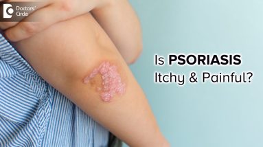 IS PSORIASIS ITCHY & PAINFUL?Ways to stop Psoriasis with Ayurveda-Dr.Chaithanya K S |Doctors' Circle 12 1683835440 maxresdefault