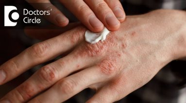 What is included in topical treatment for Psoriasis?-Dr. Sravya Tipirneni 4 1683879618 maxresdefault