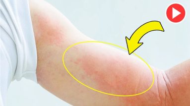 How To Cure Hives Naturally At Home | Soothe Hives With These Natural Remedies - Remedies One 10 1683905453 maxresdefault
