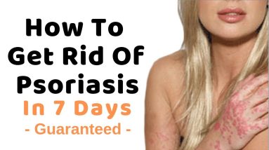 How to Get Rid of Psoriasis - New 2019 6 1683912757 maxresdefault
