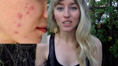 How To Cure Acne Naturally: Top 5 Secrets To Get Rid of Acne Forever - NO MEDICATIONS! 4 1683916400 maxresdefault