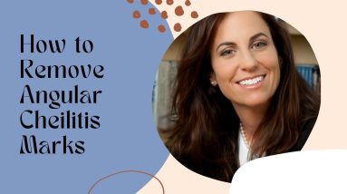 How To Remove Angular Cheilitis Marks - How To Remove Angular Cheilitis Marks 6 1684008727 maxresdefault
