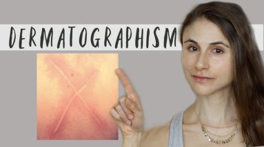 Dermatographism (cause & treatments)| Q&A with dermatologist Dr Dray 4 1684049471 maxresdefault