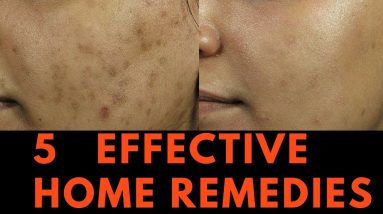 5 EFFECTIVE Home Remedies for Skin Pigmentation, Brown Spots and freckles 6 1684154753 maxresdefault