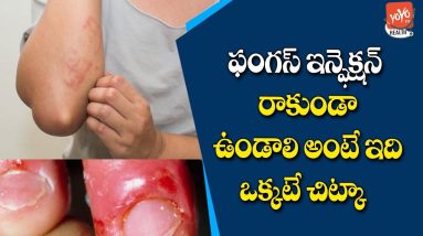 Fungal Infection Tips | Advanced Fungal Infection Treatment | Telugu Health Tips | YOYO TV Health 20 1684685836 maxresdefault