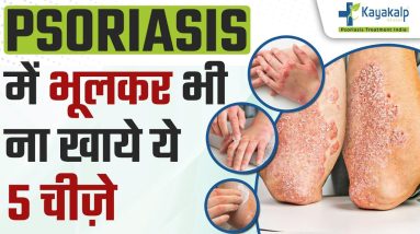 सोरायसिस में भूलकर भी ना खाये ये 5 चीज़े | 5 Foods to avoid in #Psoriasis | सोरायसिस मे क्या न खाये? 10 1684828334 maxresdefault