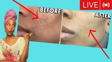 TOP 3 THINGS I DID TO HEAL MY ACNE NATURALLY | The Gut Skin Connection 6 1684832020 maxresdefault