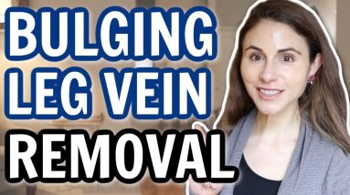 Leg vein removal: varicose veins & spider veins | Dermatologist @DrDrayzday 20 1684837335 maxresdefault