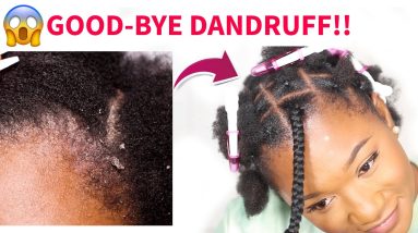 Unbelievable! 😱 How I Got Rid of Dandruff in 1 Wash! NO MORE FLAKES 16 1684840762 maxresdefault