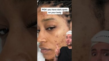 POV: you have dark spots!😱 (follow for more!💗) #skincare #skincareroutine #beauty #acne #skin 12 1684844418 maxresdefault