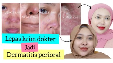 PERJUANGAN SEMBUH DARI DERMATITIS PERIORAL - Krim Etiket Biru - CREAM PEMUTIH | By Vapinka Makeup 8 1684850472 maxresdefault