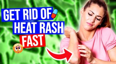 How To Get Rid of Heat Rash | Best Tips 8 1684936639 maxresdefault