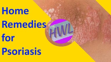 Home Remedies for Psoriasis 4 1684943958 maxresdefault