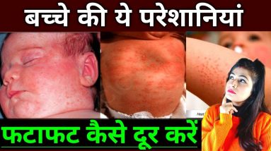बच्चों के चेहरे पर छोटे छोटे लाल दाने होना l Baby Prickly Heat Rashes Remedy @ReshusBabyCare 20 1685364055 maxresdefault