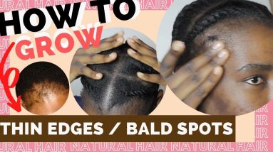How to care for thin edges | Seborrheic Dermatitis | Natural Hair 10 1685691012 maxresdefault