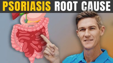 Psoriasis and Leaky Gut | The Role of Leaky Gut in Skin Conditions 12 1686923091 maxresdefault