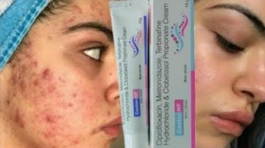 Castor nf Skin Cream Se Kya hota hai | Castor nf Cream Kaise Use Kare | Castor nf cream review 20 1687114758 hqdefault