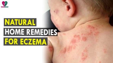 Natural Home Remedies For Eczema || Health Sutra - Best Health Tips 6 1687375523 maxresdefault