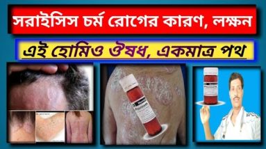 চর্ম রোগের হোমিওপ্যাথি চিকিতসা।। সরায়সিস রোগ থেকে মুক্তি পান ।। gramin homoeo 16 1687679556 hqdefault
