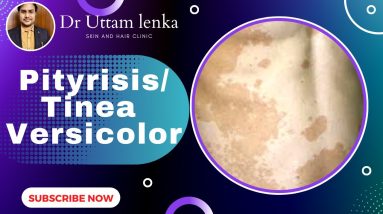 Pityrisis/Tinea Versicolor (Sehua/Siuli/Chhuli/phula chhau), Cause, prevention & treatment. 14 1687682831 maxresdefault