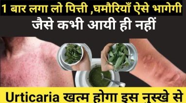 1 बार लगाते ही पित्ती,फोड़ा फुन्सी घमौरियाँ ऐसे गायब होगीं जैसे कभी था ही नहीं शरीर में I Urticaria 12 1687686582 hqdefault