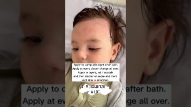 Top 10 Tips to Heal Baby Eczema 20 1688235561 maxresdefault