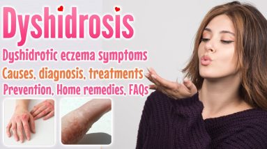 Dyshidrosis Overview, Causes, Symptoms, Diagnoses, Treatment, Home Remedies, Prevention and FAQs 14 1688246600 maxresdefault