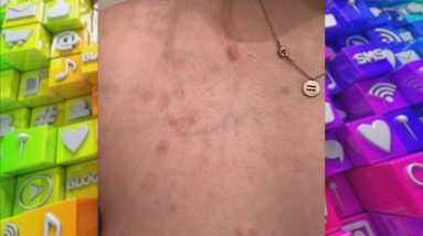 Woman’s Skin Regularly Blisters, Pops & Scabs – Can It Be Treated? 6 1688261357 maxresdefault