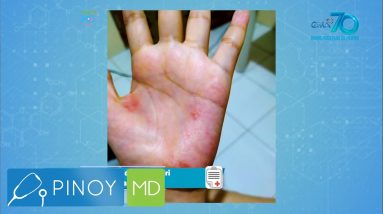 Pinoy MD: Paano maiiwasan ang pangagati dulot ng eczema? 2 1688268651 maxresdefault