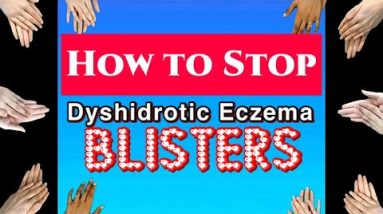 HOW I STOPPED DYSHIDROTIC ECZEMA AND BLISTERS FOR GOOD! 16 1688279728 hqdefault