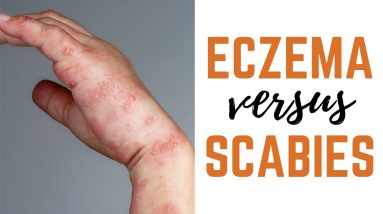 Scabies vs. Eczema: Causes, Symptoms & Treatments 10 1688290672 maxresdefault