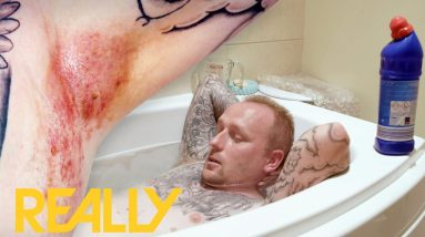 Man Has To Bathe In Bleach To Treat Blisters In The Groin | The Bad Skin Clinic 2 1688305402 maxresdefault