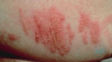 How to tell if a rash needs medical attention 18 1688312728 maxresdefault