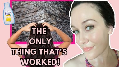 How I QUICKLY got rid of my itchy, dry scalp within ONE WEEK -(eczema and psoriasis) 12 1688378486 maxresdefault