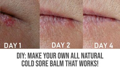 DIY: Make Your Own All Natural Cold Sore Balm That Works! 6 1688378638 maxresdefault