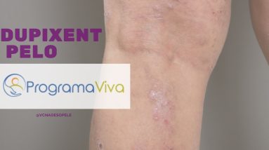 Dupixent - Pelo programa Viva 14 1688383599 maxresdefault