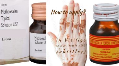 How to apply Methoxsalen solution in vitiligo? | Soak PUVA-Sol |Method-1 |(தமிழ்|हिंदी|বাংলা|മലയലാം) 2 1688385976 maxresdefault