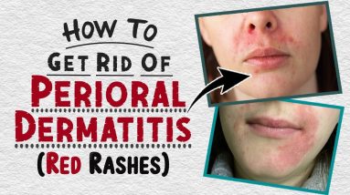 How to Get Rid of Perioral Dermatitis | Home Remedies for Perioral Dermatitis Treatment 4 1688401987 maxresdefault