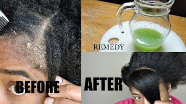HOME MADE REMEDY FOR DANDRUFF CURE || THIS WILL GET RID OF YOUR DANDRUFF 20 1688477655 hqdefault