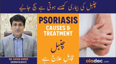 Psoriasis Skin Disease - Psoriasis Kya Hai - Chumbal Ka Ilaj - Psoriasis Causes & Treatment In Urdu 14 1688551102 maxresdefault