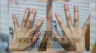 GAMOT SA BUTLIG NA MAY TUBIG/EZCEMA 4 1688573382 maxresdefault