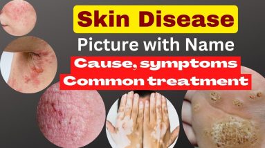 skin disease picture with name | skin problem with name,cause, symptoms, common treatment, nsg.care 16 1688588063 maxresdefault
