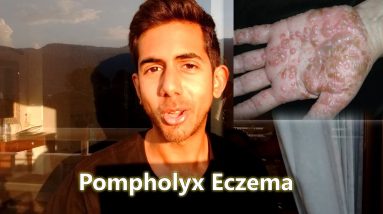 Pompholyx Eczema | How to Deal with it Naturally 14 1688591719 maxresdefault