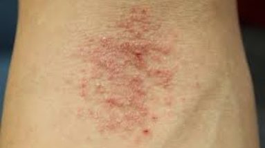 Eczema Types causes Signs and symptoms 4 1688610098 hqdefault